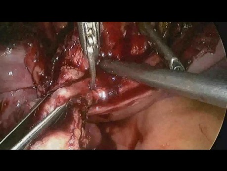 Laproscopic Isthmocele Repair in c/o Previous 2 LSCS