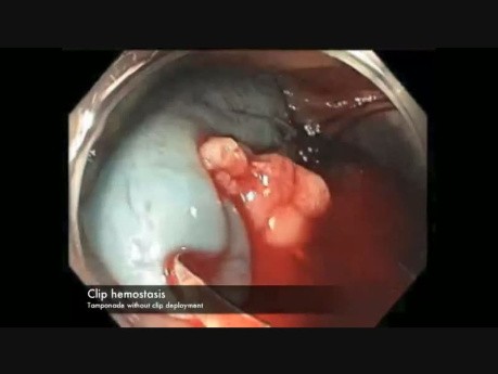 Cecum - EMR of A Large Sessile Polyp Complicated By Bleeding