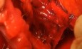 Radical Hysterectomy Resection of Vesico-Uterine Ligament