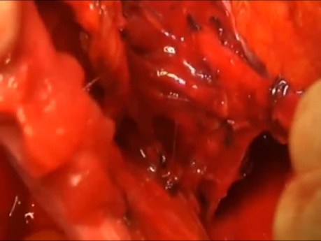 Radical Hysterectomy Resection of Vesico-Uterine Ligament