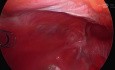Laparoscopic TAPP of Left Direct Inguinal Hernia Plus Obturator Hernia with Defect Closure