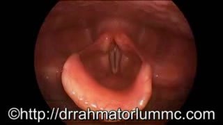 Movements of arytenoid vocal process upon phonation