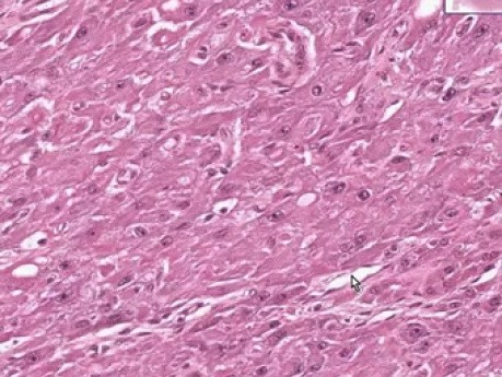 Squamous cell carcinoma