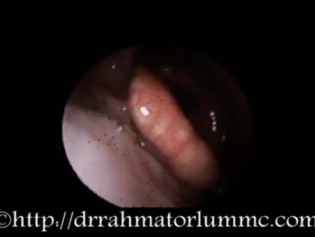 Laryngeal Oedema Due To Hypersensitivity Reaction