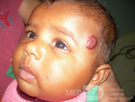 Haemangioma Of The Scalp