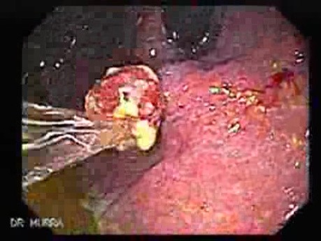 Ulcerated Hyperplastic Polyp (2 of 4)