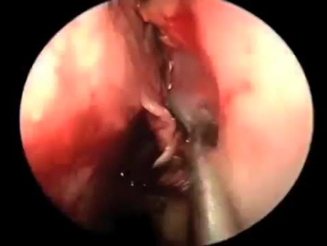 Transnasal Approach for Surgery of the Pituitary Gland
