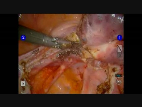 Harmonic Scalpel Use for Hysterectomy Robotically