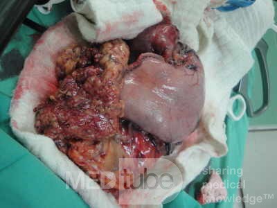 Gastric Ulcerated Adenocarcinoma of the Pre-pyloric Antrum (20 of 28)