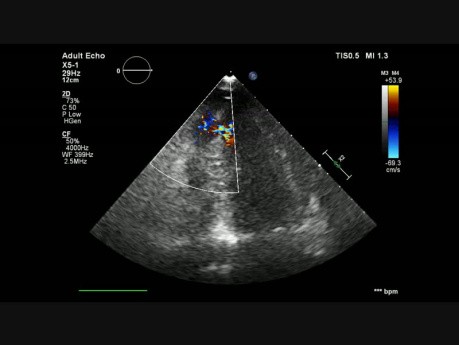 VSR After Anterior MI