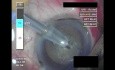 Cataract Surgery - Part 2