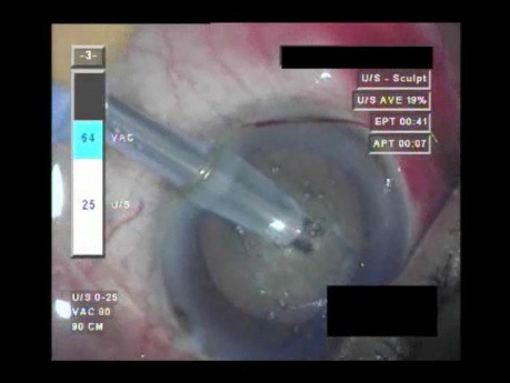 Cataract Surgery - Part 2