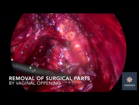 Uterus/Bladder Endometriosis and Nodule on the Left Obturator Nerve