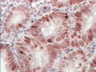 Early Gastric Cancer (20 of 21)
