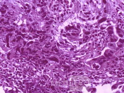 Gallbladder Adenocarcinoma and litiasis (13 of 13)