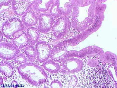 Sessile Tubulovillous Adenoma  (13 of 13)