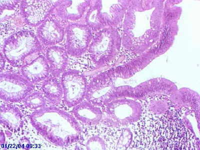 Sessile Tubulovillous Adenoma  (13 of 13)