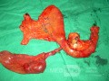 Resected Gut With Cyst