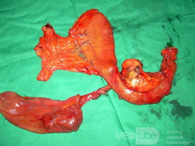 Resected Gut With Cyst