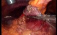 Gastrointestinal Stromal Tumor - GIST (44 of 65)