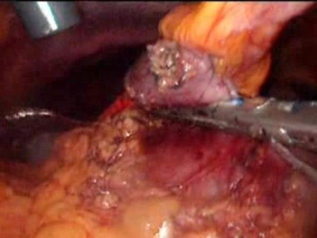 Gastrointestinal Stromal Tumor - GIST (44 of 65)