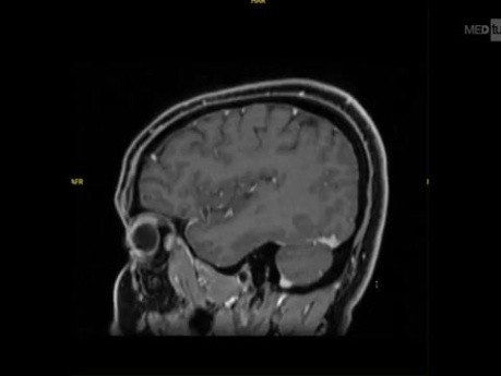 Endoscopic Transnasal Approach for Resection of Pituitary Adenoma