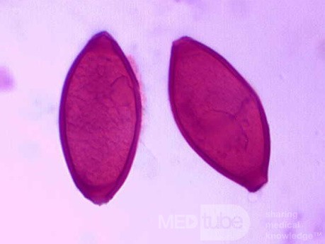Colonoscopy observing a trichuris in the cecum (5 of 8)