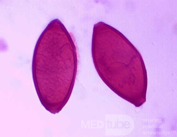 Colonoscopy observing a trichuris in the cecum (5 of 8)