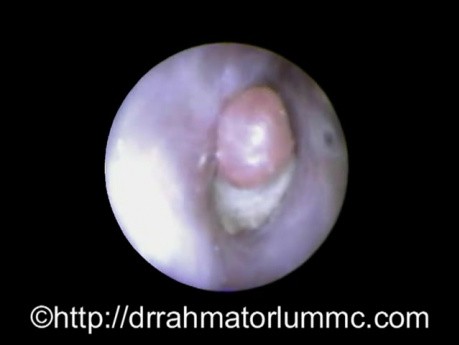 Retained Q-Tip Cotton in The Ear Passage