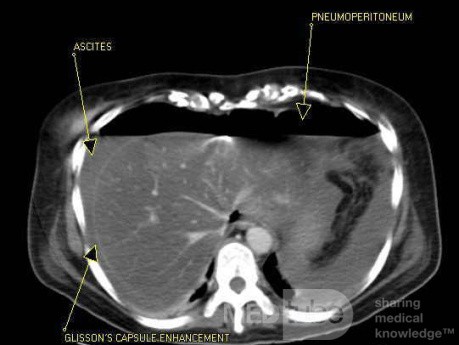 Multiple Rectal Ulcers (44 of 110)