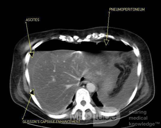 Multiple Rectal Ulcers (44 of 110)