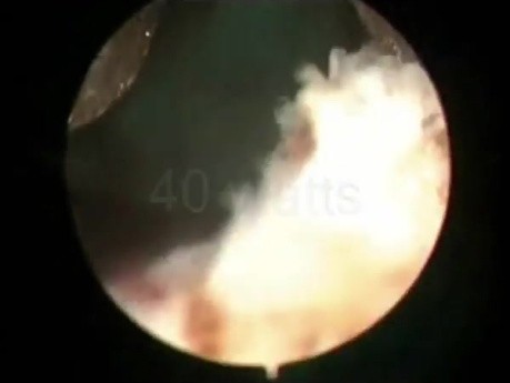 Greenlight HPS Prostatectomy - Part 2