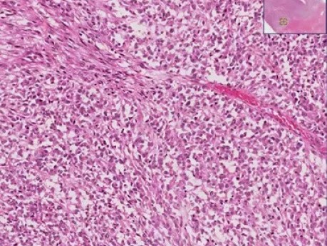 Leiomyosarcoma