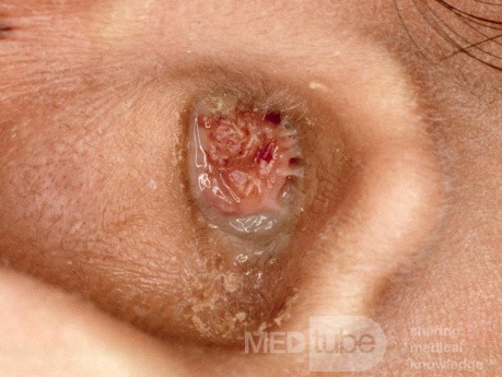 Large Aural Polyp