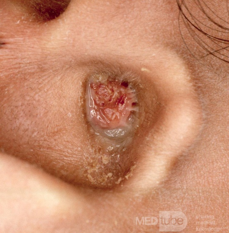 Large Aural Polyp