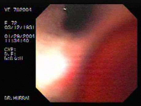 Mallory-Weiss Syndrome - Erosion in Phase of Healing