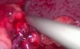 Thermometer Probe Transection During Sleeve Gastrectomy