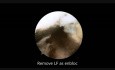Unilateral Biportal Decompression with 30 degree Endoscopy