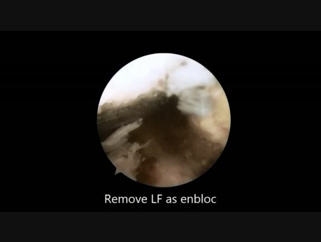 Unilateral Biportal Decompression with 30 degree Endoscopy