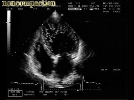 LV Noncompaction