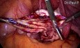 Ovarian Endometrial Cyst Removal