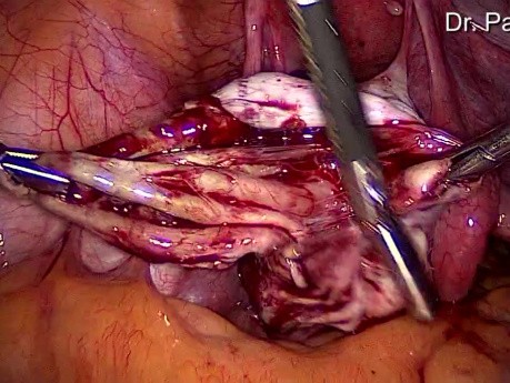 Ovarian Endometrial Cyst Removal