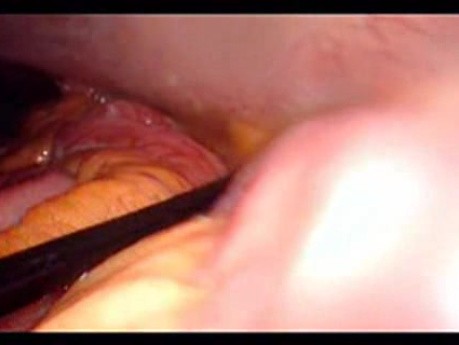 Colonic Perforation With Peritonitis - Laparoscopy (33 of 46)