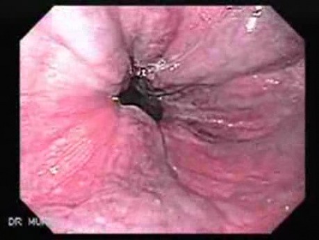 Esophageal Variceal Bleeding - Varices in the Area of Gastroesophageal Junction
