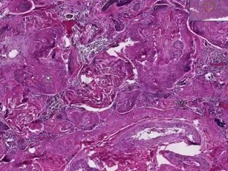 Sickle cell disease