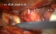 PCA Intracranial Aneurysm Directly Clipped Through Pterional Transylvian Approach Using Retrocarotid Window
