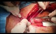 Management of Patient with Tracheo Innominate Artery Fistula Post Tracheal Resection