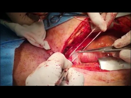 Management of Patient with Tracheo Innominate Artery Fistula Post Tracheal Resection