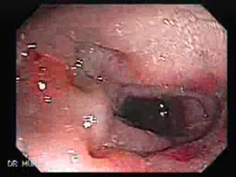 Diverticular Colitis (6 of 7)