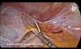 Hydrosalpinx and Tubal Recurrent Torsion A Late Complication of Tubal Ligation
